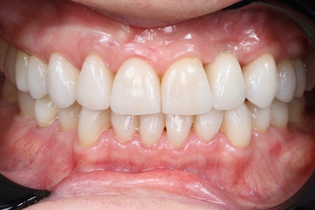 Porcelain Veneers